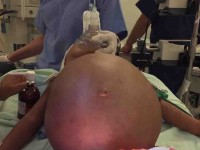 Un éxito la cirugía de tumor renal en Hospital del Niño